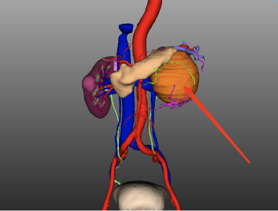 哈醫(yī)大二院泌尿外科運用達(dá)芬奇手術(shù)機(jī)器人 精準(zhǔn)切除腎上腺巨大腫瘤